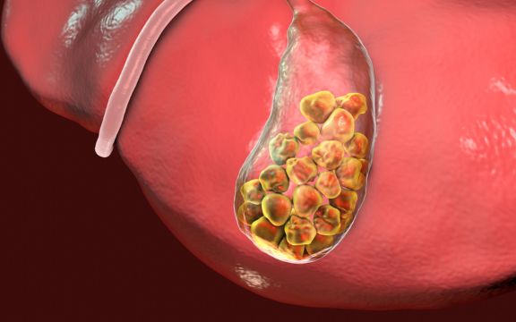 Gallstone Removal