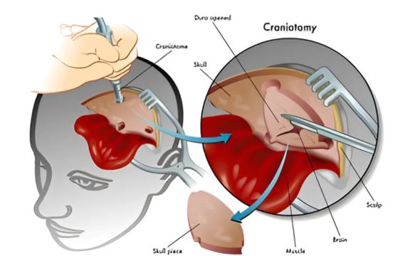 Laser-Assisted Craniotomy