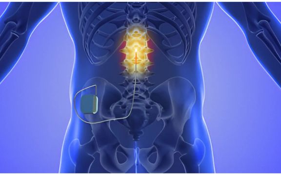 Spinal Cord Stimulation