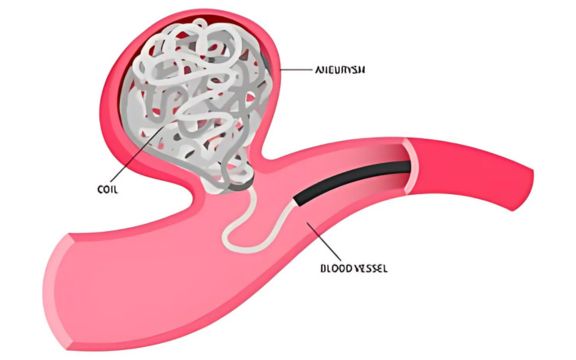 Cerebral Aneurysm Clipping and Coiling