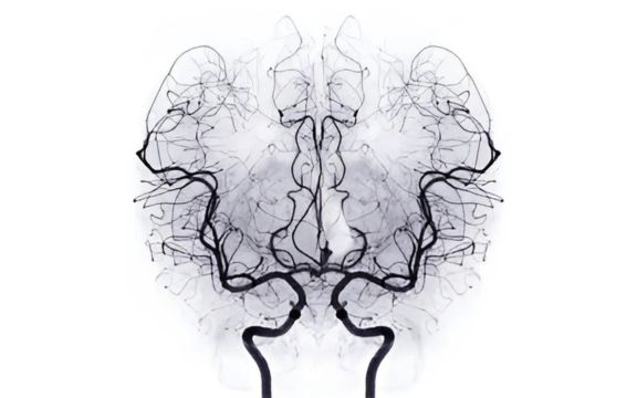 Cerebral Angiography